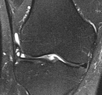 MRI Lateral Meniscal Cyst 2